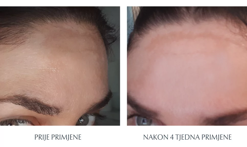 Eucerin Anti Pigment prije i poslije, rezultati tretmana
