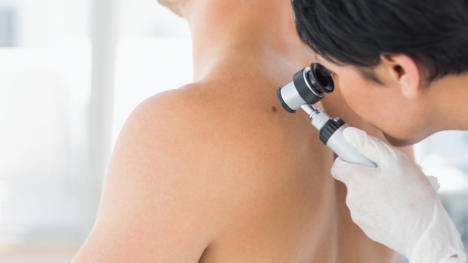 Eucerin projekt Ne čekaj CHECKiraj zaštita kože od UV zračenja